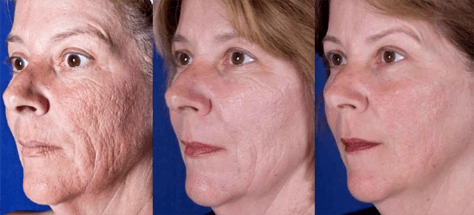 Result after laser facial skin rejuvenation procedure