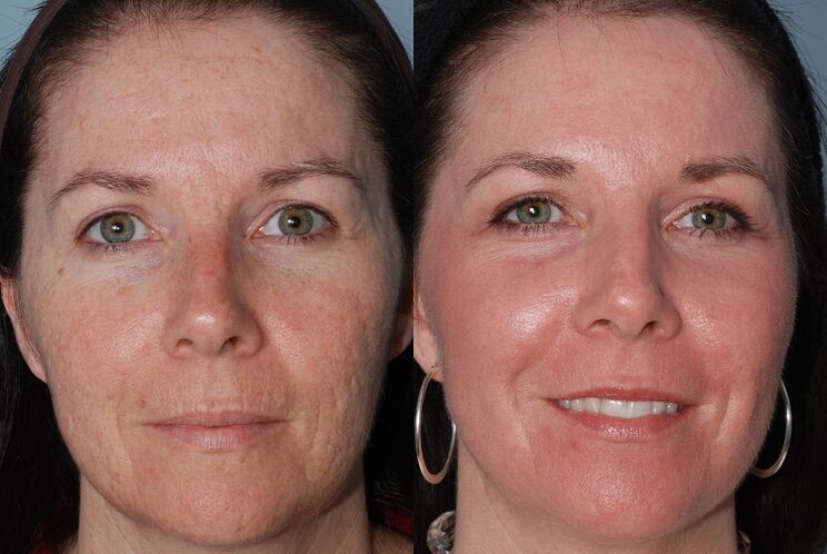 before and after skin rejuvenation with hardware